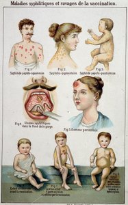 لوحة توضح المساكن المختلفة لأمراض الزهري وأخطار التطعيم - في الطب الطبيعي بلز ، أواخر القرن التاسع عشر. بواسطة فنان غير معروف
