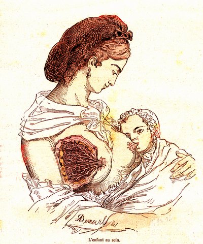 الطفل في الثدي (حياة جي رينجاد الطبيعية وصحته) - الرضاعة الطبيعية. رسم أ. ديمارل 1881 بواسطة ألفونس ديمارلي