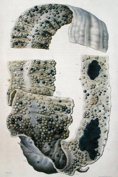 أمراض الأمعاء ، من "Anatomie Pathologique du Corps Humain" بقلم جان كروفيلهير (1791-1874) 1828-42 (نقش ملون) بواسطة انطوان شزال