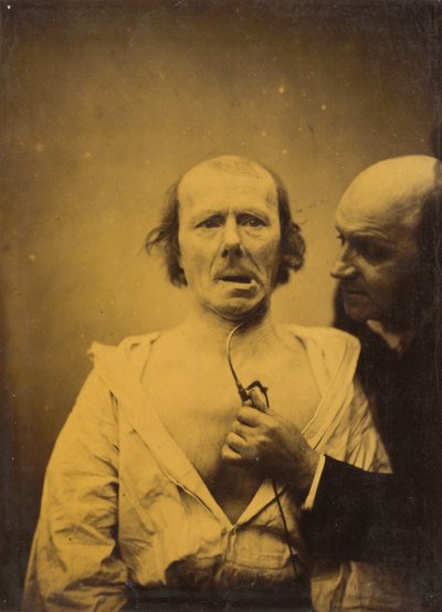 هذا الانكماش م. platysma وحدها تفتقر إلى التعبير ، 1854-1856 ، طبعت عام 1862. بواسطة دوشين دي بولوني