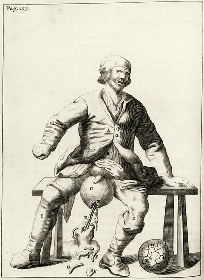 تصريف السوائل من القيلة الصفنية ، من التمارين العملية لعلاج الطريقة بواسطة فريدريك ديكرز ، 1694 بواسطة المدرسة الهولندية