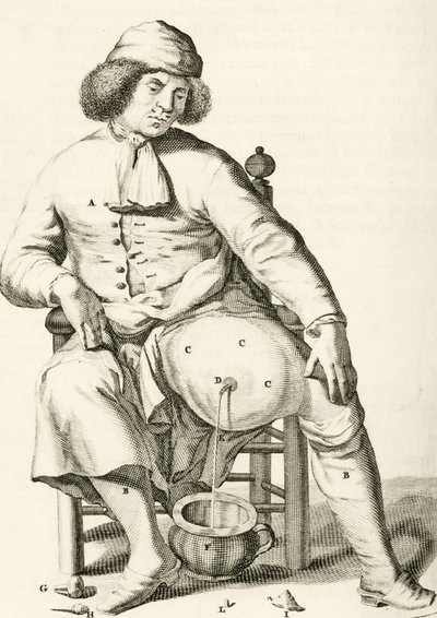 تصريف السوائل من الخراج ، من التمارين العملية إلى طريقة الشفاء بواسطة فريدريك ديكرز ، 1694 بواسطة المدرسة الهولندية