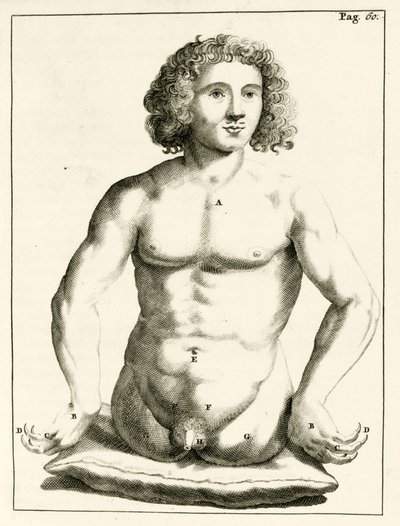 مثال على العيوب الخلقية ، من التمارين العملية إلى طريقة العلاج بواسطة فريدريك ديكرز ، 1694 بواسطة المدرسة الهولندية