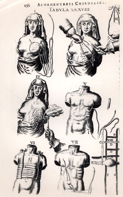 العمل على سرطان الثدي ، من Armamentarii Chirurgici بقلم يوهانس شولتس (1595-1645) المنشور في أمستردام ، 1672 بواسطة المدرسة الهولندية