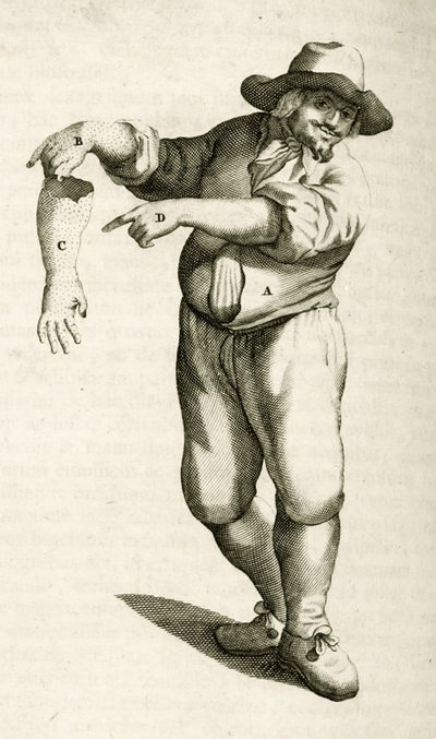 إزالة الجلد الميت بالبثرات ، من التمارين العملية لعلاج الطريقة بواسطة فريدريك ديكرز ، 1694 بواسطة المدرسة الهولندية