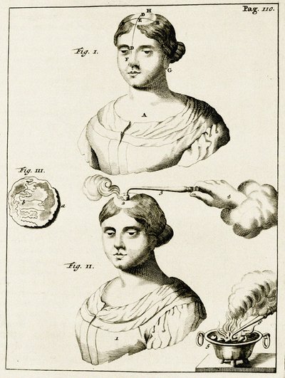علاج مرضى الصرع ، من التمارين العملية إلى طريقة الشفاء بواسطة فريدريك ديكرز ، 1694 بواسطة المدرسة الهولندية