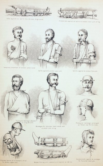 العلاج المؤقت للكسور ، c.1890 بواسطة مدرسة اللغة الإنجليزية