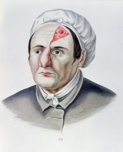 بعد عملية ترقيع الجلد ، من Selecta Praxis Medico-Chirurgica من ألكسندر أوفرت ، باريس ، 1856 بواسطة المدرسة الفرنسية
