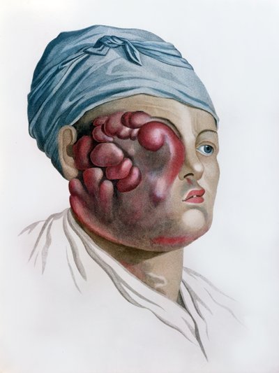 داء السرطان ، من الوصف des Maladies de la Peau للبارون جان لويس عليبرت (1768-1837) باريس ، 1806 بواسطة المدرسة الفرنسية