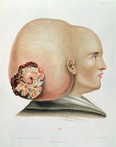 فطر الأم الجافية ، من Selecta Praxis Medico-Chirurgica بقلم ألكسندر أوفيرت ، باريس ، 1856 بواسطة المدرسة الفرنسية