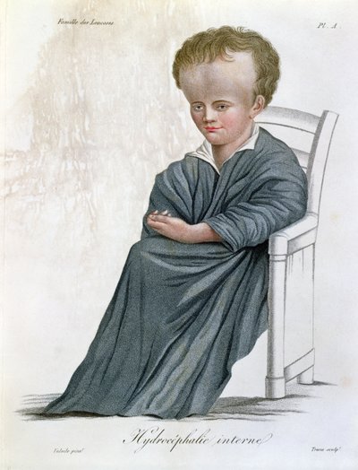 استسقاء داخلي ، من Nosologie Naturelle بواسطة البارون جان لويس عليبرت (1768-1837) منقوش بواسطة Tresca ، 1817 بواسطة المدرسة الفرنسية