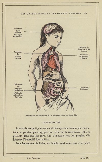 Manifestations caracteristiques de la tuberculose chez une jeune fille (colour litho) بواسطة المدرسة الفرنسية
