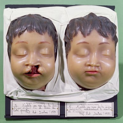 نموذج يظهر وجه طفل قبل وبعد عملية لتصحيح آفة شعرية قام بها أنطوان دوبوا (1756-1837) عام 1799 (شمع) بواسطة المدرسة الفرنسية