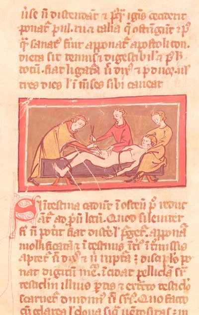 السيدة H 89 fol.23 الجراحة ، من طبعة من كتاب الجراحة بقلم روجير دي ساليرن بواسطة المدرسة الفرنسية