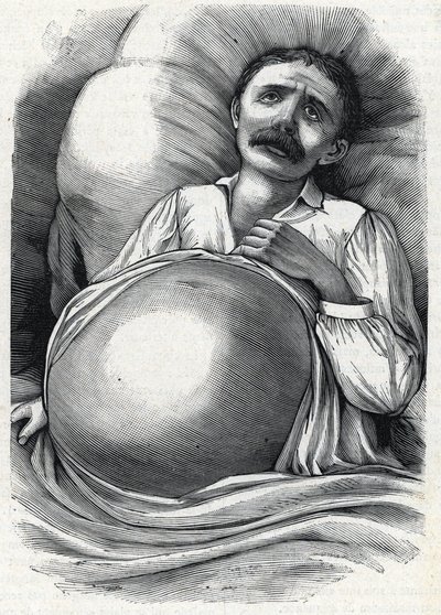 مريض بتليف كبدي متقدم (نقش) 1888 بواسطة المدرسة الفرنسية