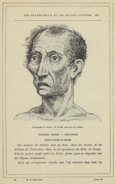 Physionomie du malade a la periode asphyxique du cholera (colour litho) بواسطة المدرسة الفرنسية