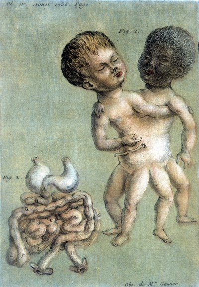 لوحة طبية تمثل الإخوة السياميين: أبيض وأسود. رسم توضيحي لتوسان (1756) في quot;ملاحظات دورية عن الفيزياء والتاريخ الطبيعي والفنونquot;. بواسطة المدرسة الفرنسية