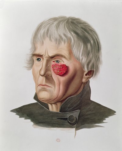 مرض جلدي قبل العملية ، من Selecta Praxis Medico-Chirurgica بقلم ألكسندر أوفيرت ، باريس ، 1856 بواسطة المدرسة الفرنسية