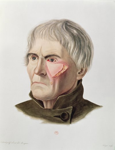 عملية ترقيع الجلد ، من Selecta Praxis Medico-Chirurgica من ألكسندر أوفيرت ، باريس ، 1856 بواسطة المدرسة الفرنسية