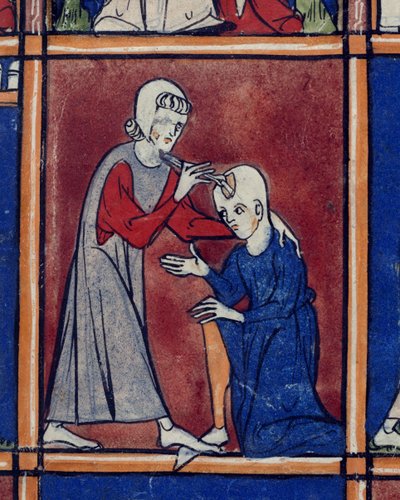 Sloane 1977 f.2 عملية على جمجمة مريض ، رسم توضيحي من "Chiurgia" ، بقلم روجر فروغاردي من بارما ، حوالي 1300-10 (رق) بواسطة المدرسة الفرنسية