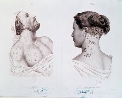 أعراض مرض الزهري لدى الرجال والنساء ، من كتاب طبي ، c.1850-60 بواسطة المدرسة الفرنسية