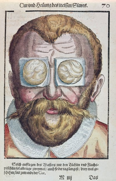 علاج حالة العين ، من طب العيون من قبل جورج بارتيش (1535-1636) المنشور في دريسدن عام 1583 (طبعة خشبية ملونة) بواسطة المدرسة الألمانية