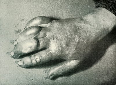 دكتور أتكينسونز فروست-بيتين هاند ، 5 يوليو 1911 ، 1913 بواسطة هربرت بونتينج