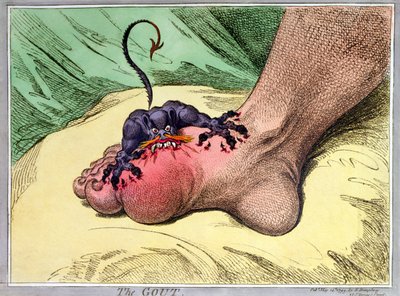 النقرس ، نشرته هانا همفري عام 1799 (نقش أرضي ملون يدويًا) بواسطة جيمس جيلراي