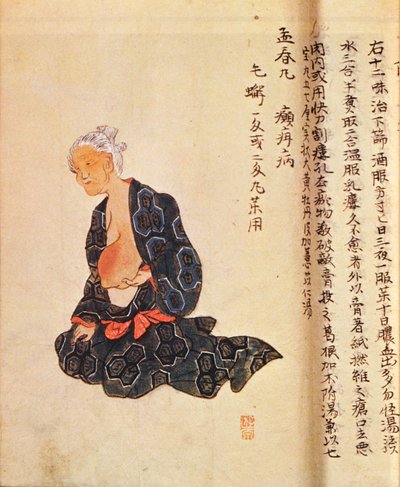 أول علاج جراحي لسرطان الثدي يتم تحت التخدير العام بواسطة Seishu Hanaoka (1760-1836) عام 1804 بواسطة المدرسة اليابانية