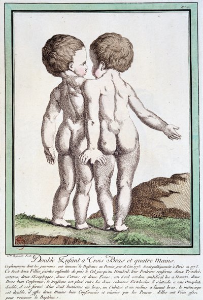 Siamese children - in “” Les deviations de la nature”” by Régnault بواسطة جان بابتيست ريغنولت
