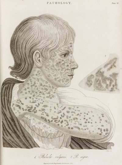 Diseases, Measles Two types of measles بواسطة ريتشارد (بعد) داد