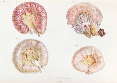 السطح الخارجي للأمعاء المصابة بالكوليرا ، من Anatomie Pathologique du Cholera Morbus ، بواسطة نيكولاي إيفانوفيتش بيروغوف (1810-1881) المنشور في سانت بطرسبرغ ، 1849 بواسطة المدرسة الروسية