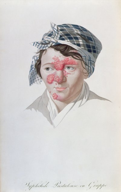 البثور العنقودية الزهرية ، من كتاب البارون جان لويس عليبرت (1768-1837) 1838 بواسطة سلفادور تريسكا