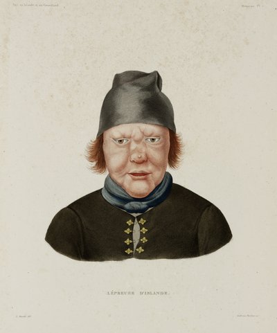 Diseases, Leprosy Female leper, Iceland, early 19th century بواسطة غير معروف