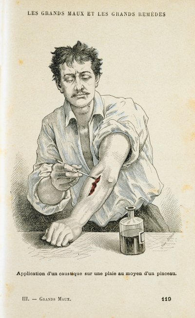 طلاء الجرح بمحلول مطهر ، c1890 بواسطة غير معروف