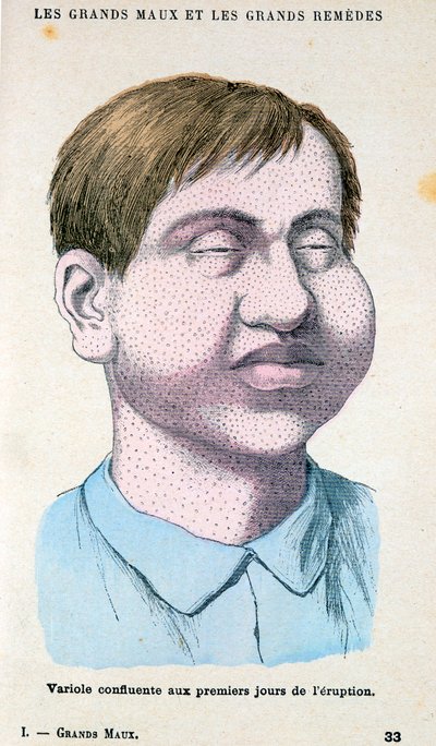 ضحية الجدري ، c1890 بواسطة غير معروف