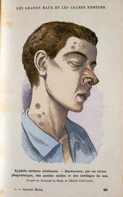 أعراض المرحلة الثالثة من مرض الزهري ، القرن التاسع عشر بواسطة غير معروف