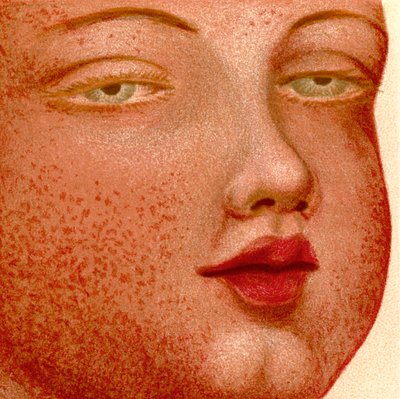 الحمى البركانية: القرمزية أو الحمى القرمزية بواسطة فنان غير معروف