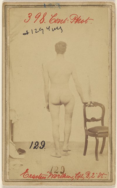 كسر في الثلث العلوي من عظم الفخذ. إيراستوس ورثن، من شركة كورب. B. 2nd Vermont Vols. البالغ من العمر 25 عاماً - مقيم في ستوكبريدج في فيرمونت. بواسطة فنان غير معروف