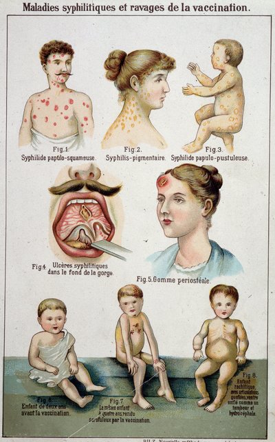 لوحة توضح المساكن المختلفة لأمراض الزهري وأخطار التطعيم - في الطب الطبيعي بلز ، أواخر القرن التاسع عشر. بواسطة فنان غير معروف