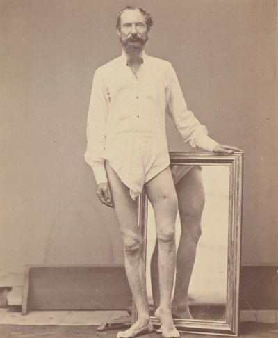 جرح ناري في الثلث الأوسط من عظم الفخذ الأيسر ، 1865-1867. بواسطة ويليام اتش بيل