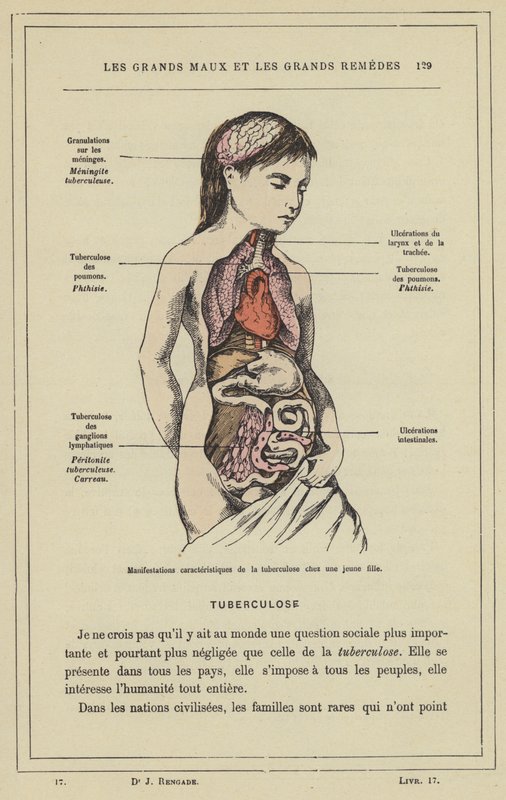 Manifestations caracteristiques de la tuberculose chez une jeune fille (colour litho) بواسطة المدرسة الفرنسية