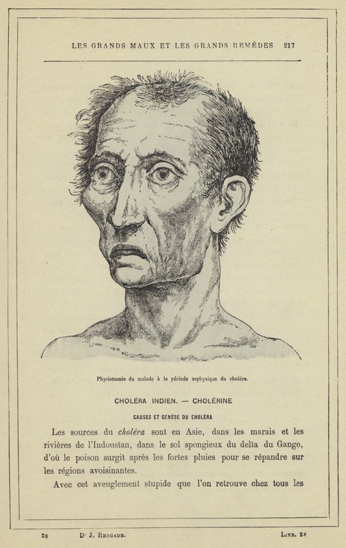 Physionomie du malade a la periode asphyxique du cholera (colour litho) بواسطة المدرسة الفرنسية