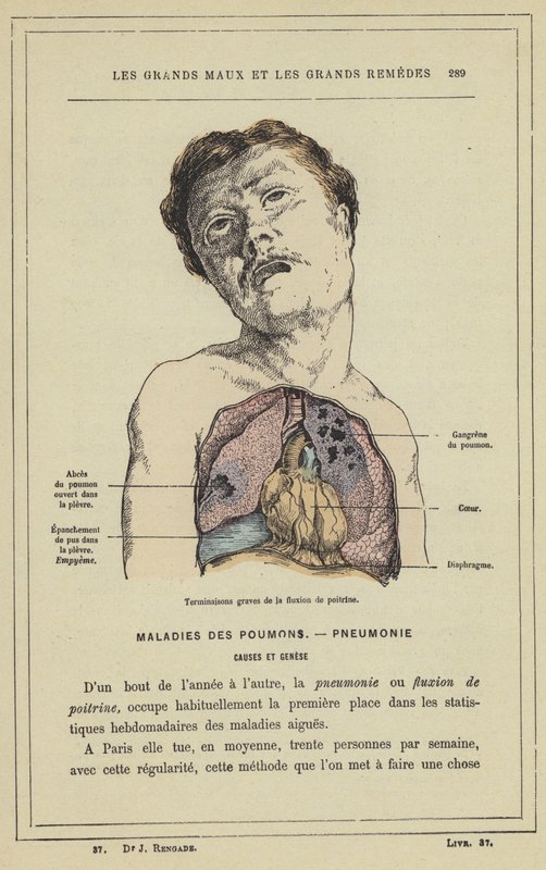 Terminaisons graves de la fluxion de poitrine (colour litho) بواسطة المدرسة الفرنسية